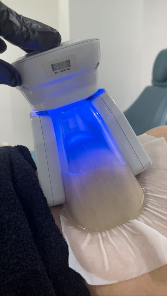 Criolipólisis en VIVE Medical Spa Cancún