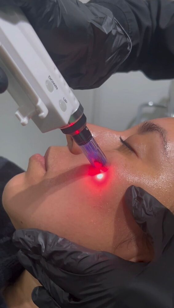 Microneedling en VIVE Medical Spa Cancún