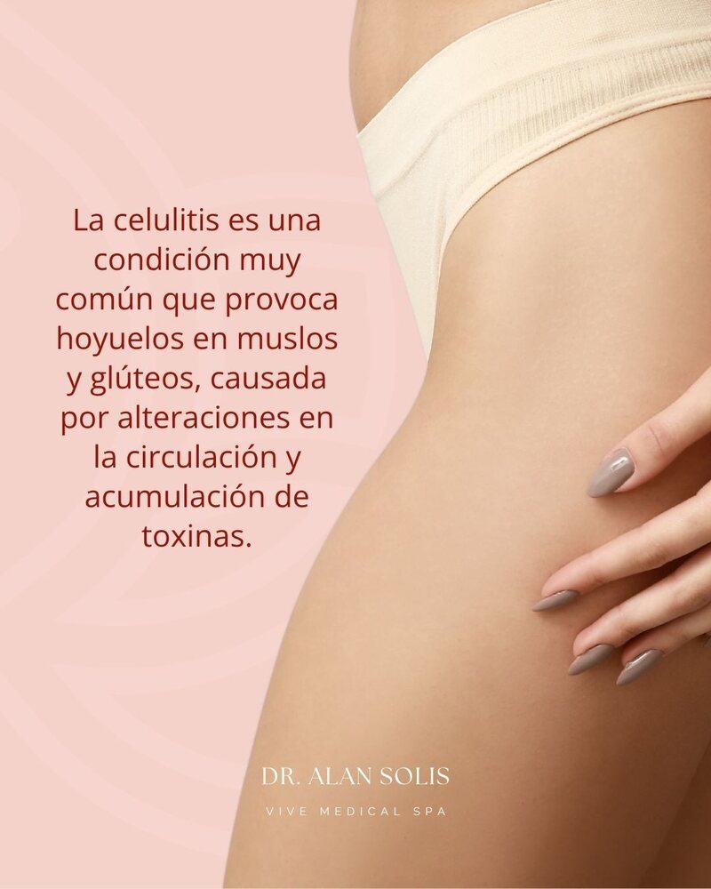 Qué es la celulitis — VIVE Medical Spa Cancún